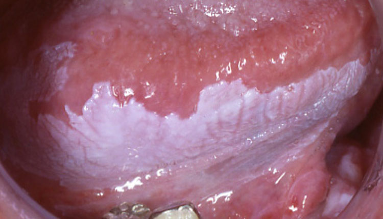 Leucoplachia Orale